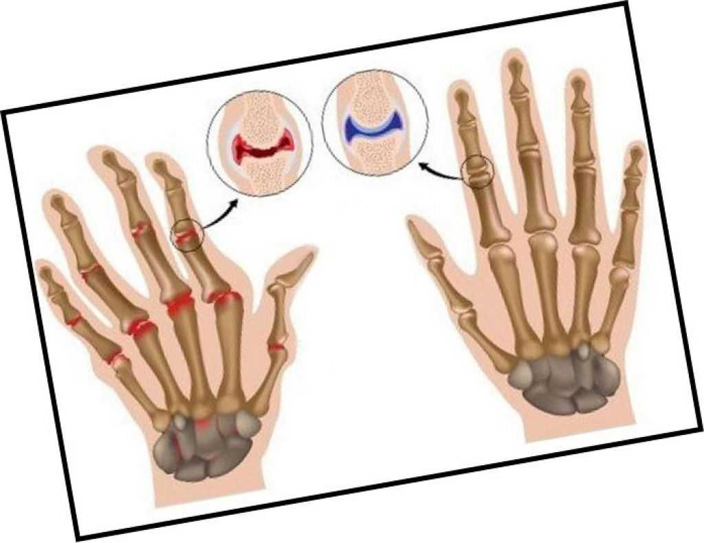 Артроз кистей рук - симптомы и лечение заболевания суставов