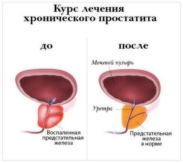 Лечение симптомов патологии нижних мочевых путей при аденоме предстательной железы. часть 3